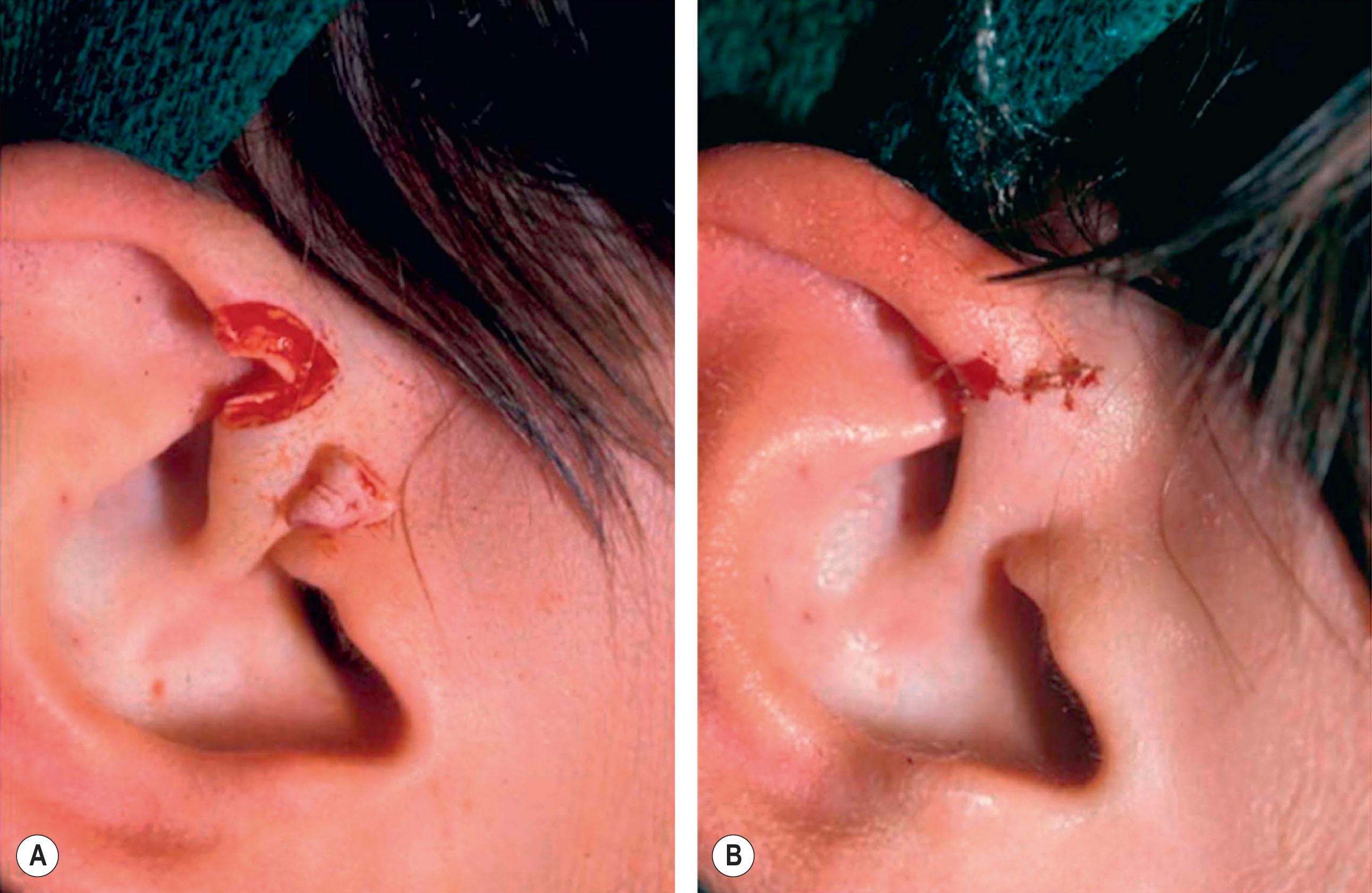 Figure 19.5, Technique 1: (A,B) Harvest of a small composite graft (<1 cm) with primary closure by running the dog-ear anteriorly into the hairline. This closure preserves contour of the ear.