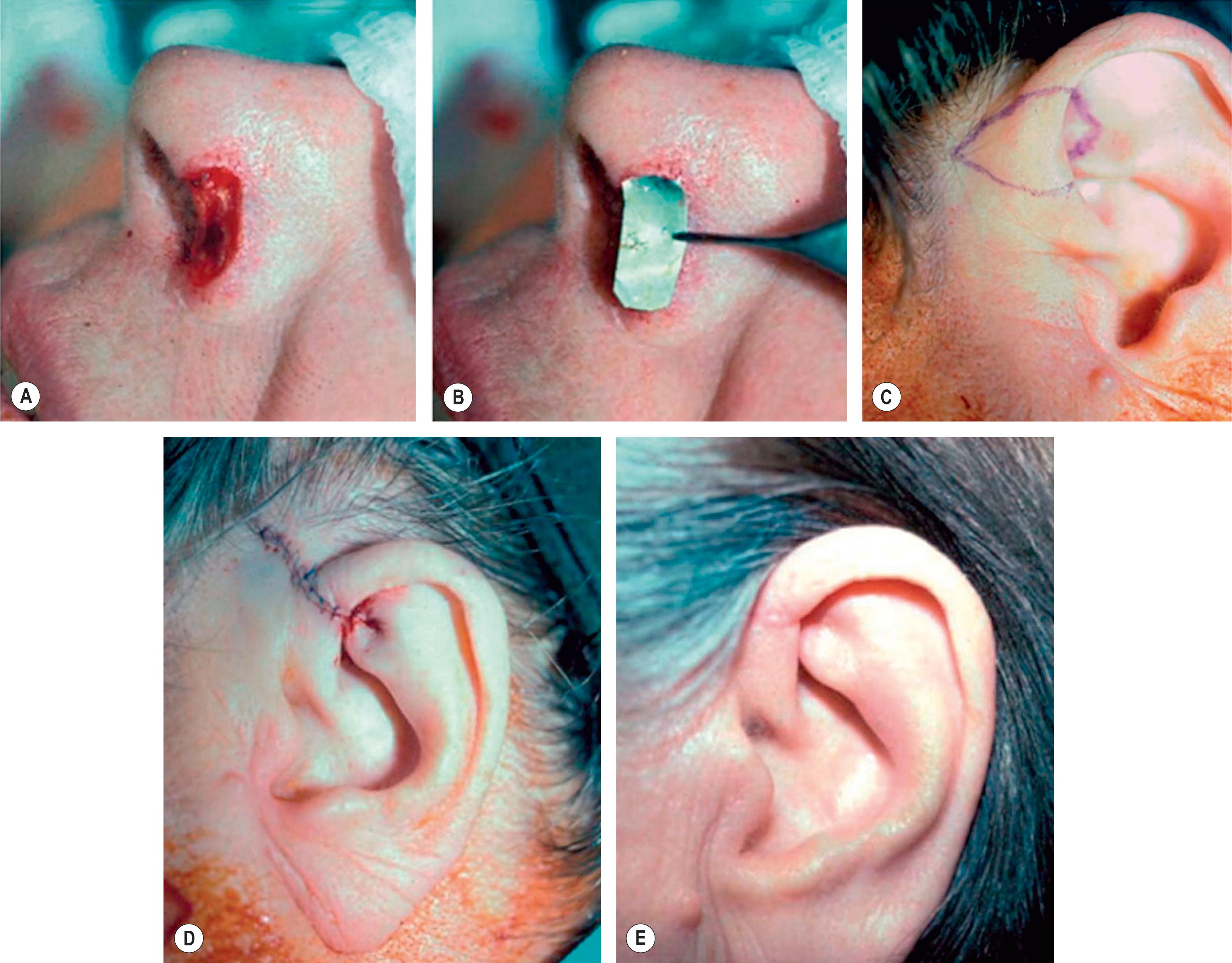 Figure 19.6, Technique 2: (A–C) A wider defect of the alar rim requires a larger composite graft from the helical base, as seen by the markings on the ear. (D,E) Closure of the defect is accomplished by running the dog-ear anteriorly into the hairline and posteriorly into the triangular fossa. A full-thickness wedge of cartilage must be removed from the triangular fossa to prevent buckling of the ear.