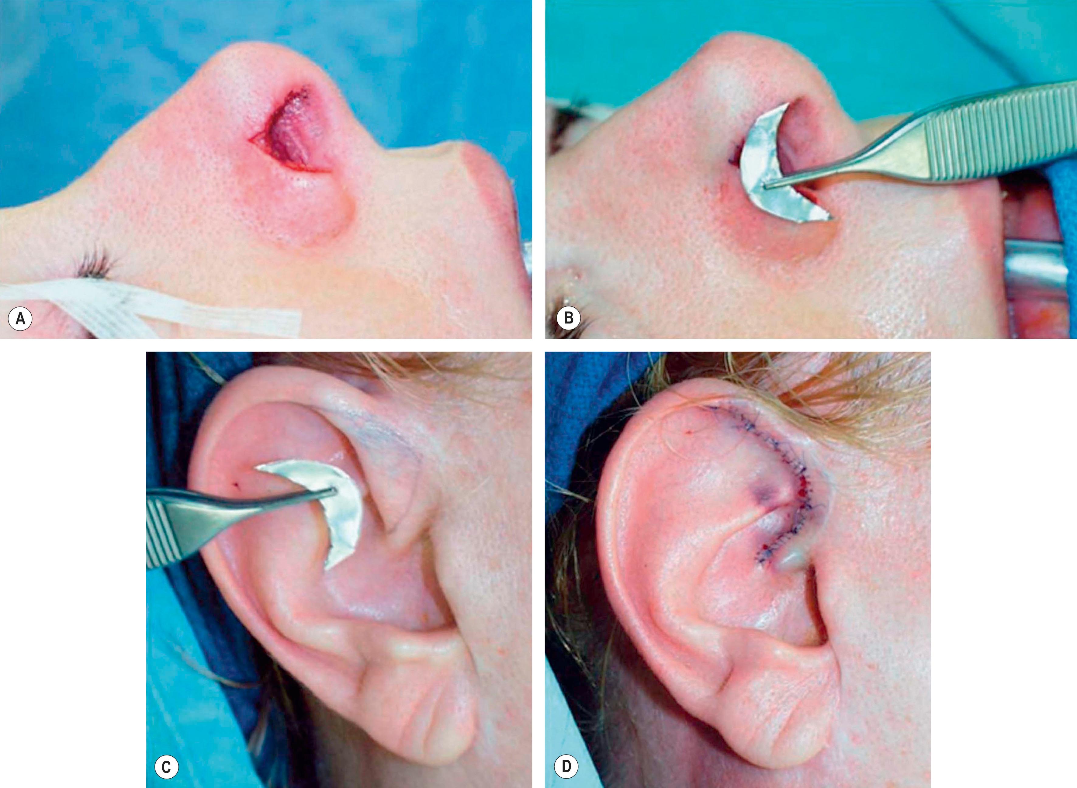 Figure 19.7, Technique 3: (A,B) The nasal defect is wide but short in its vertical dimension. This allows harvest from the anteroinferior helical rim. (C,D) Primary closure is achieved by running the dog-ear superiorly and inferiorly.