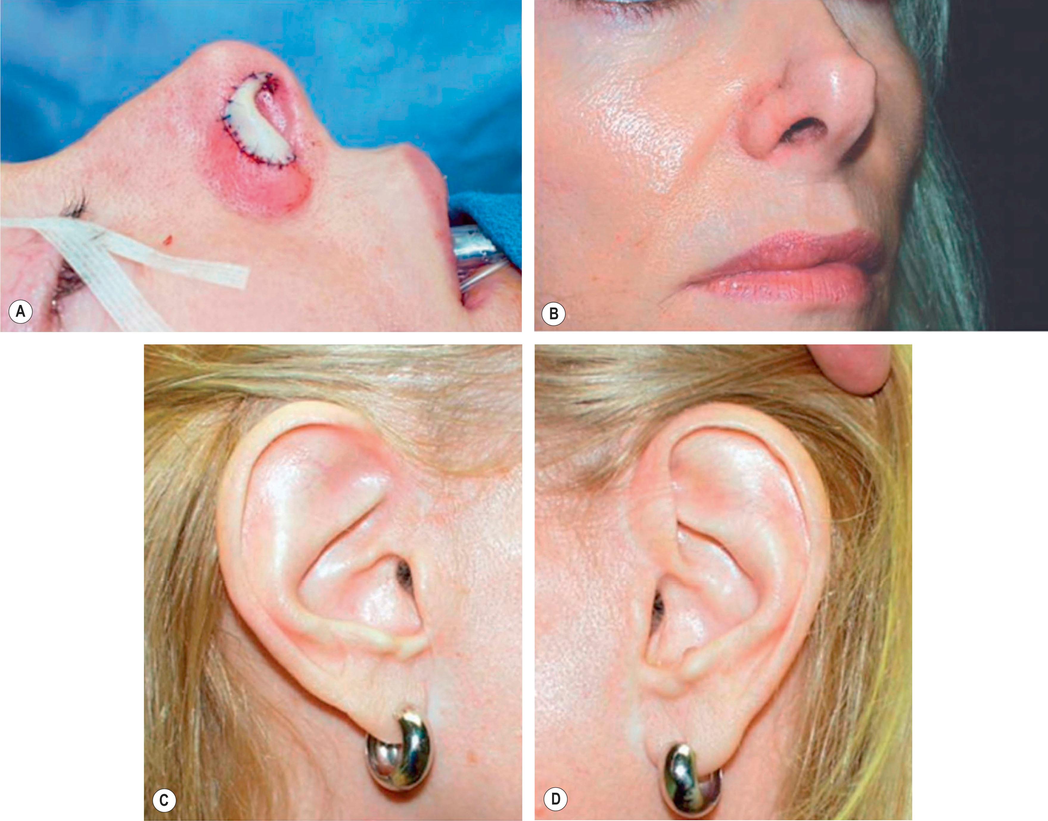 Figure 19.8, Technique 4: (A,B) Inset of graft and aesthetic outcomes of nasal reconstruction and (C) the auricular donor site in comparison with (D) the contralateral ear.