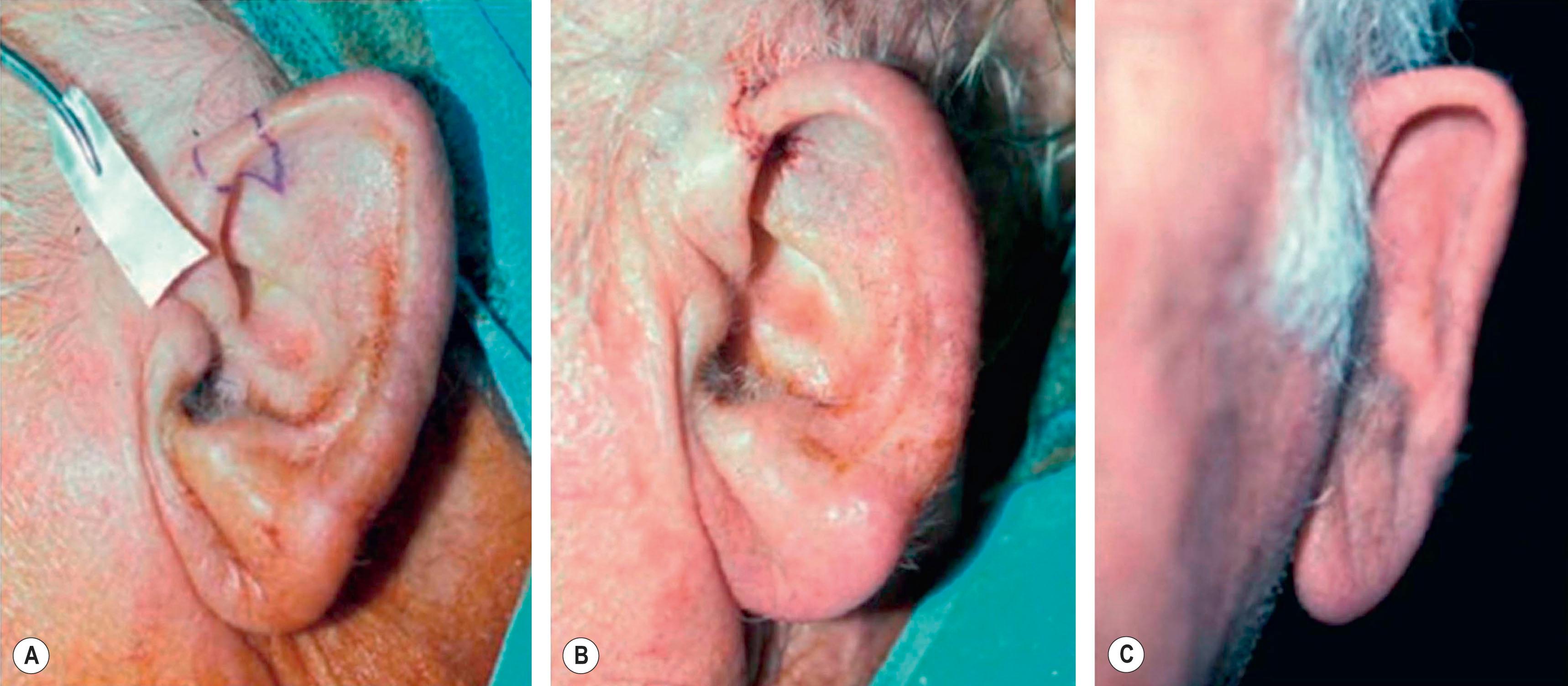 Figure 19.9, (A–C) With harvest of a small (1–1.2 cm) composite graft, closure can be achieved by helical rim advancement. However, overprojection of the ear may result, as seen in this series of photographs.