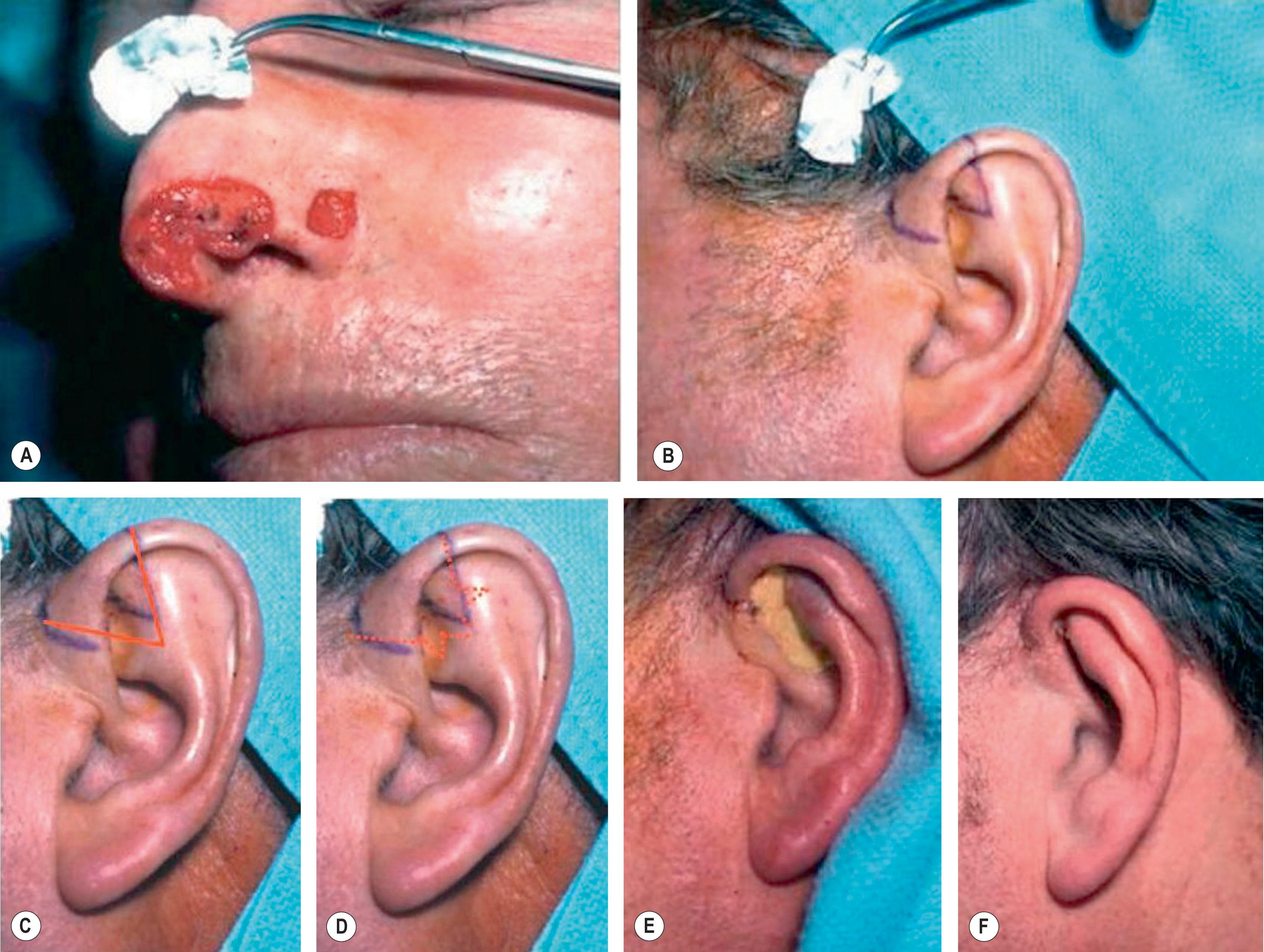 Figure 19.10, Technique 5: (A,B) This nasal defect requires a larger composite graft with a width of 1.8 cm. The harvest site on the auricle is demonstrated by the purple lines. (C–E) To overcome distortion and overprojection resulting from tissue harvest, closure for this size auricular defect involves a V-shaped wedge of skin and a half-star pattern of cartilage excision at the apex of the V. The solid lines indicate skin incision and the dotted star pattern demonstrates cartilaginous incisions. In addition, a postauricular incision with a scaphomastoid suture is performed. (F) This technique of wound closure prevents the cupping of the ear and relatively normal shape and projection of the ear are maintained after the closure.