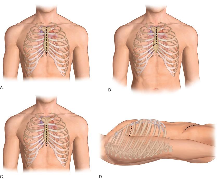 Figure 18.2, (A) Median sternotomy. (B) Partial upper sternotomy. (C) Partial lower sternotomy. (D) Right anterolateral minithoracotomy. (E) Intraoperative photograph of minimally invasive approach via right anterolateral minithoracotomy; note the use of smaller skin incisions for the placement of an endoscope, suction ports, cross-clamp, and retraction sutures.