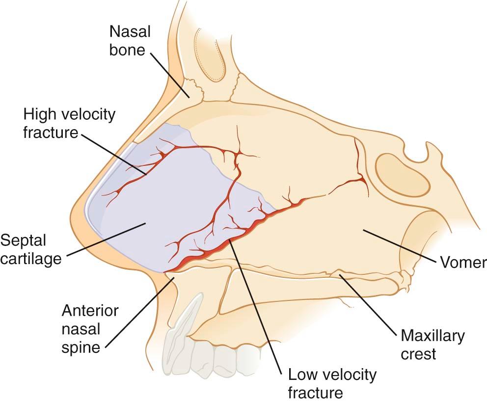 Figure 38-2, The nasal septum and patterns of septal fractures. The septal (aka quadrangular cartilage) articulates with the anterior nasal spine caudally, the perpendicular plate of the ethmoid posteriorly, and the vomer inferiorly; the vomer articulates with the maxillary and palatine crests. The septal cartilage typically rests along a groove at the midline; this is known as the vomerine groove. The most common septal fracture is along this junction between the vomerine groove and quadrangular cartilage. A high-velocity injury or frontal impact can result in a more extensive septal fracture through the thin central region of the septal cartilage and extending to the bony cartilaginous junction.