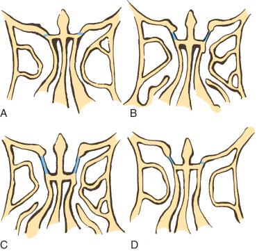 Fig. 26.1, Illustration depiction of computed tomography scans showing the Keros classification. (A) Keros Class I; (B) Keros Class II; (C) Keros Class III; (D) asymmetric skull base.