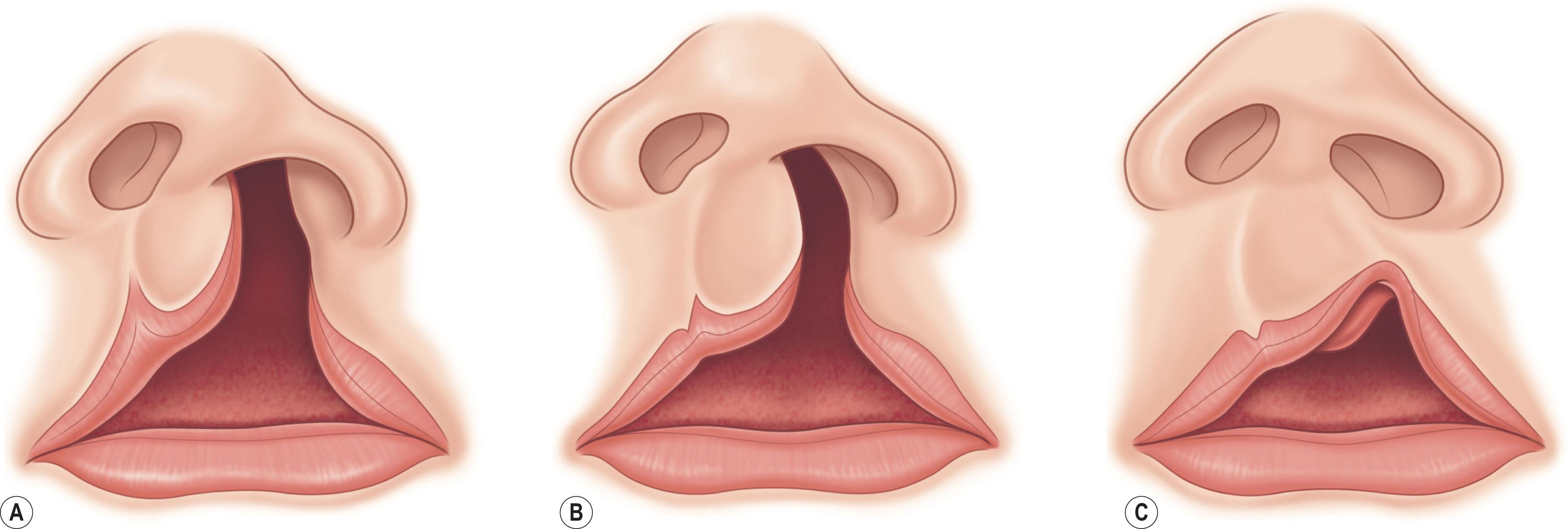 Figure 20.1, Examples of asymmetrical bilateral cleft lip with a contralateral lesser-form. (A) Left complete and right minor-form. (B) Left complete and right microform. (C) Left incomplete and right mini-microform.