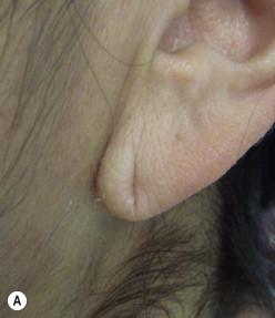 FIGURE 48.1, (A,B) Partially split earlobe.