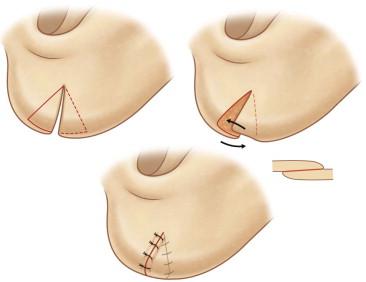 FIGURE 48.11, Partially incised V-plasty of the anterior and posterior flaps (Arora's technique).