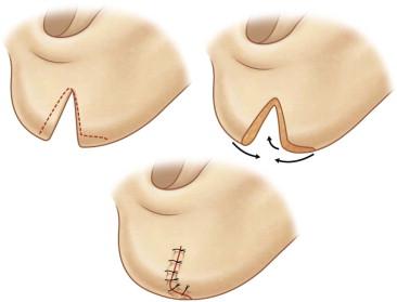 FIGURE 48.12, De-epithelialization of the wound edges (Effendi's technique).