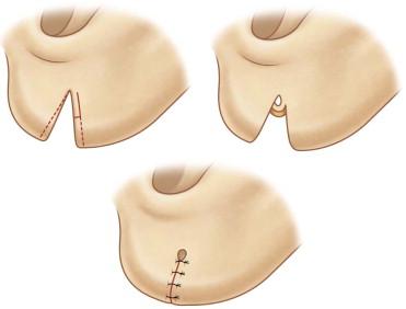 FIGURE 48.13, Creation of a flap from the lateral portion of the split lobe forms a tract for the earring (Pardue's technique).