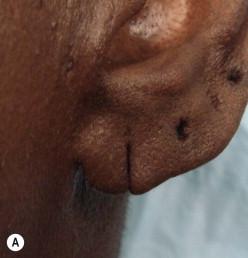 FIGURE 48.2, (A,B) Completely split earlobe.