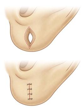 FIGURE 48.3, Repair of the partially split earlobe with side-to-side closure after de-epithelializing the split area.