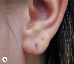 FIGURE 48.4, (A) Partially split earlobe in a 24-year-old woman. (B) A chalazion clamp is applied to stabilize the earlobe. (C) The epithelialized edges of the split are dissected and excised. Bleeding is well controlled with the chalazion clamp. (D) The resulting defect of anterior-through-posterior excision of the split edges. (E) Simple interrupted sutures placed on the anterior and posterior aspects of the earlobe. (F) At 2 months follow-up.