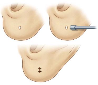 FIGURE 48.5, Punch technique to de-epithelialize the split area (Tan's technique).