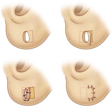 FIGURE 48.6, Parallel flaps are created on the anterior and posterior surfaces of the earlobe (Reiter & Alford's technique). 10