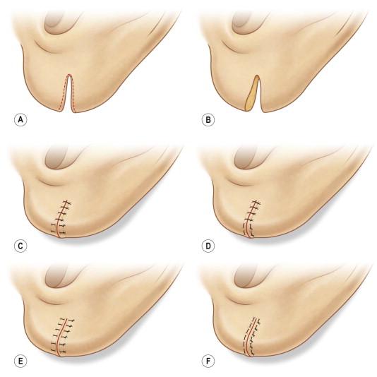 FIGURE 48.7, Use of vertical or horizontal mattress sutures to close the area. (A,B) Split earlobe. (C) Repair of rim with vertical mattress sutures and remainder of split with simple interrupted sutures. (D) Repair of rim with horizontal mattress sutures and remainder of defect with simple interrupted sutures. (E) Repair of entire split with vertical mattress sutures. (F) Repair of entire split with horizontal mattress sutures.