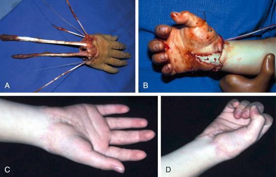 Fig. 51.2, (A) An avulsion-type injury at the level of the wrist. (B) Perfusion is reestablished. Note the use of skin graft to avoid a tight skin closure. Despite the mechanism, a good functional result is obtained with flexion (C) and extension (D).