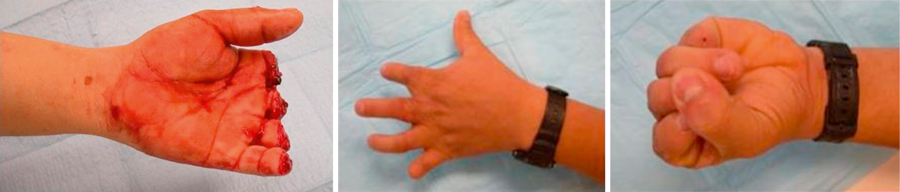 Fig. 42.2, Example of indication for replantation: multiple-finger amputations. Note the significant shortening of all digits to achieve primary nerve coaptation. Despite the shortened length, the replantation is a functional success.