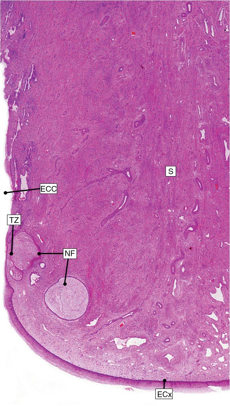 Fig. 3.13, A low-power histologic section of the cervix. The stroma (S) has a small amount of smooth muscle. The ectocervix (ECx) is covered in stratified squamous epithelium. The endocervix (ECC) is lined by tall columnar cells. NF, Nabothian follicles (a normal finding); TZ, transformation zone.