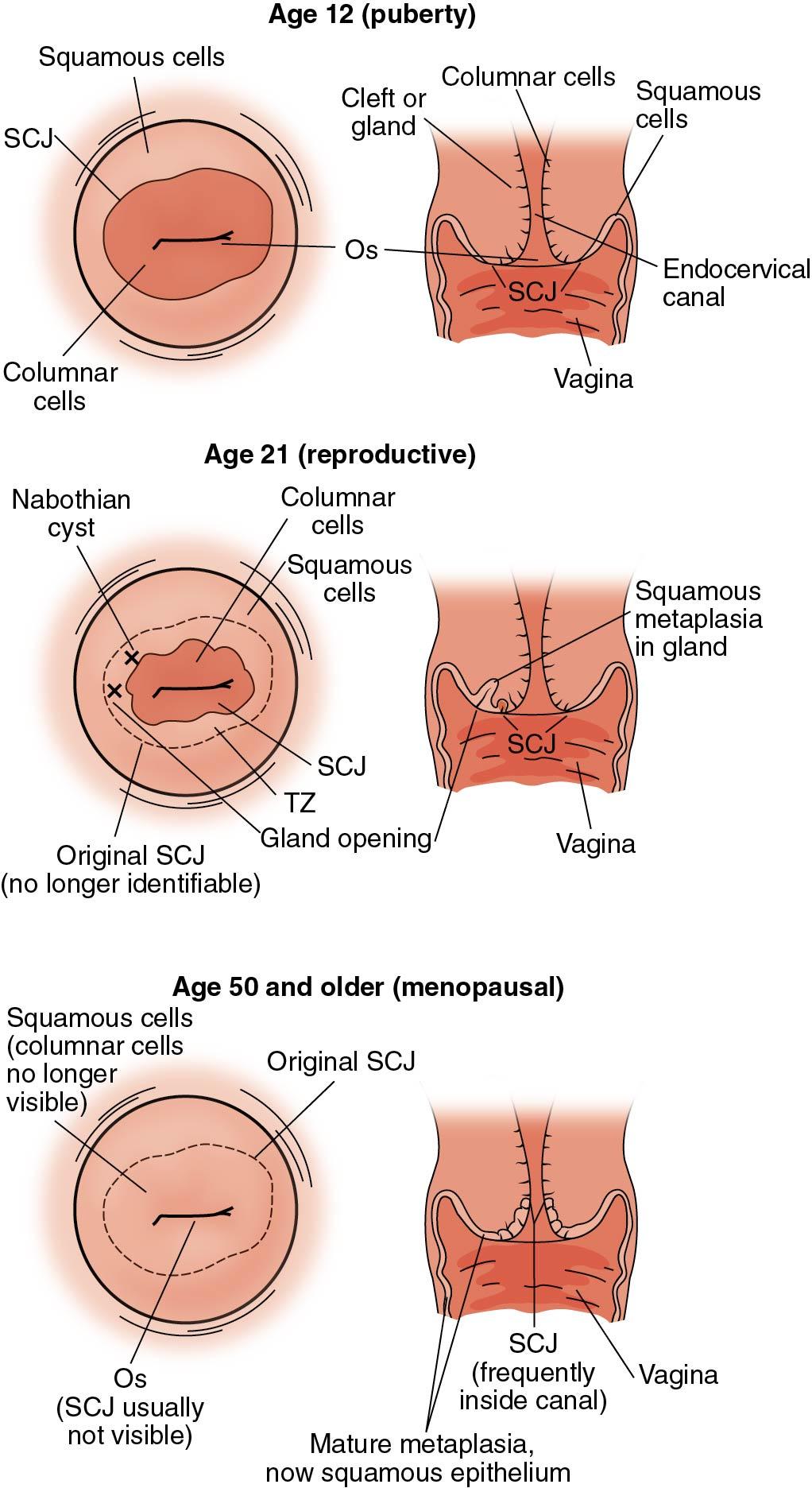 Fig. 3.14, A schematic drawing showing the migration of the transformation zone as a women ages. The first schematic shows a larger more robust squamocolumnar junction (SCJ). During the reproductive years the glands open, the SCJ migrates slightly inward, and on examination Nabothian cysts may be seen. During menopause the lack of estrogen causes the transformation zone to migrate higher up the endocervical canal. The SCJ is often lost into the cervical canal during menopause.
