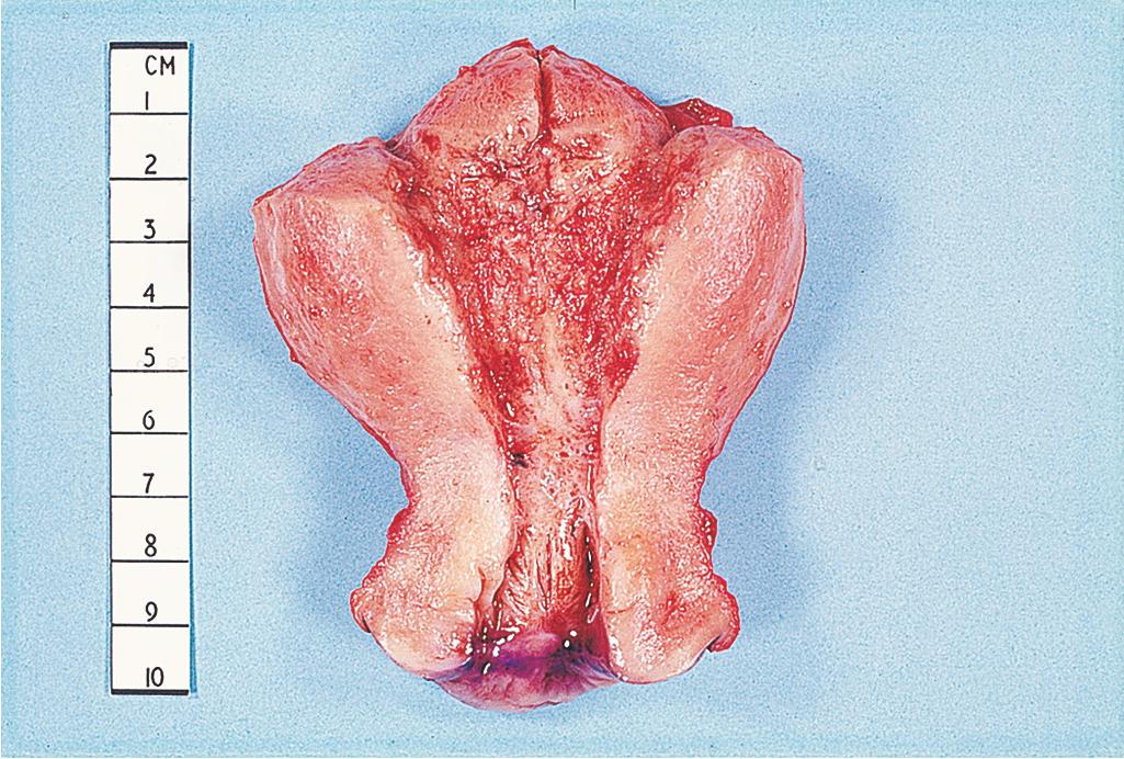 Fig. 3.15, A surgical specimen of a uterus that has been opened.