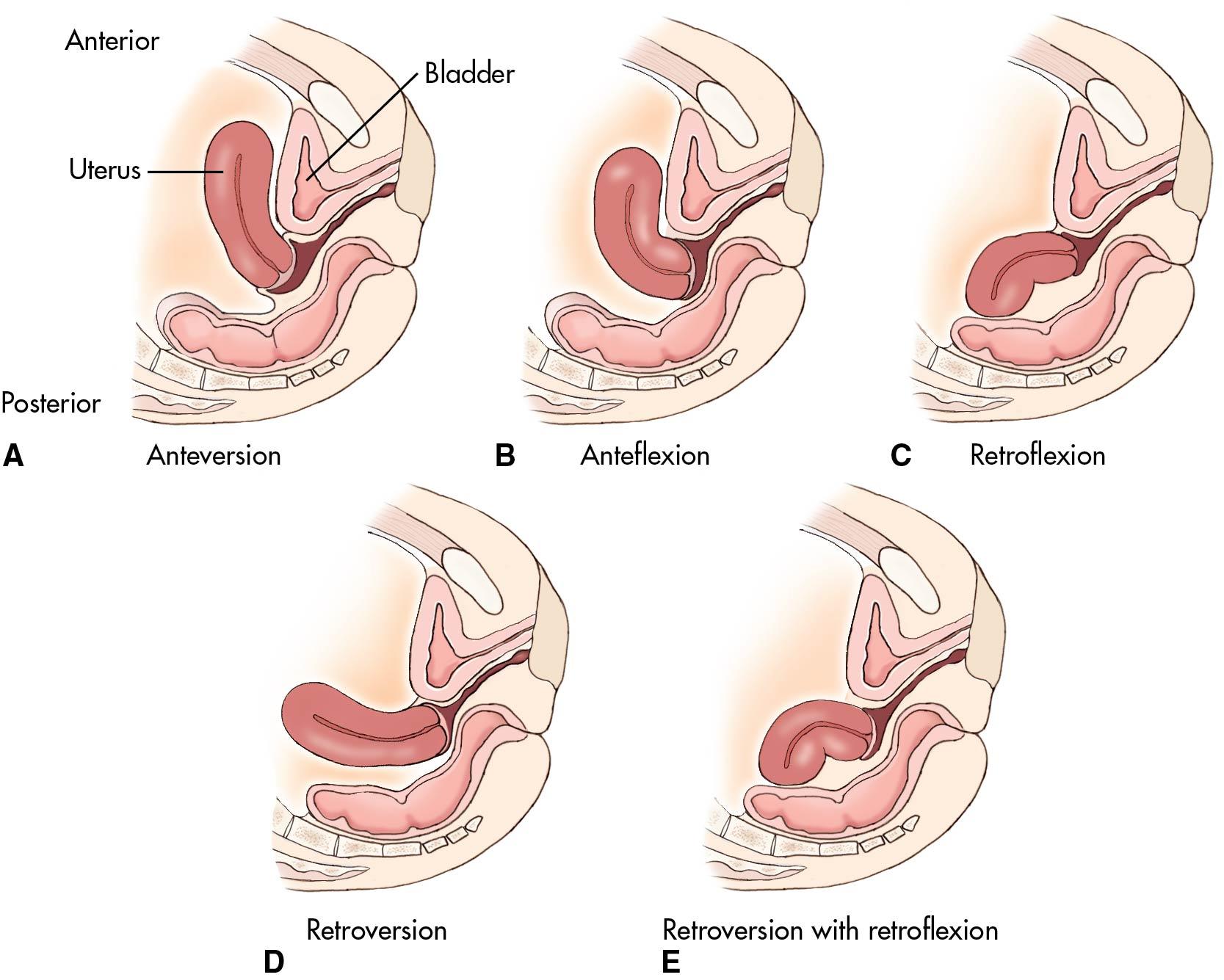 Fig. 3.16, A schematic view of the variations in the position of the uterus in relations to the cervix. A-E are all normal variants, but the most common variant is retroflexion, (C) which is palpable in more than 25% of patients and may make visualization of the cervix challenging during a speculum examination.