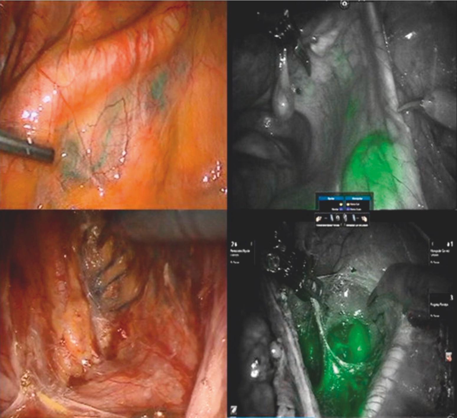 Fig. 3.18, Intraoperative view of sentinel lymph node mapping with isosulfan blue dye on the left and indocyanine green on the right.