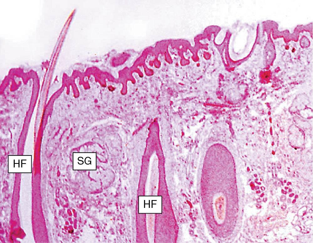 Fig. 3.2, Histologic section from the labia majora. Note the eccrine glands and ducts. HF , Hair follicles; SG , sebaceous glands.