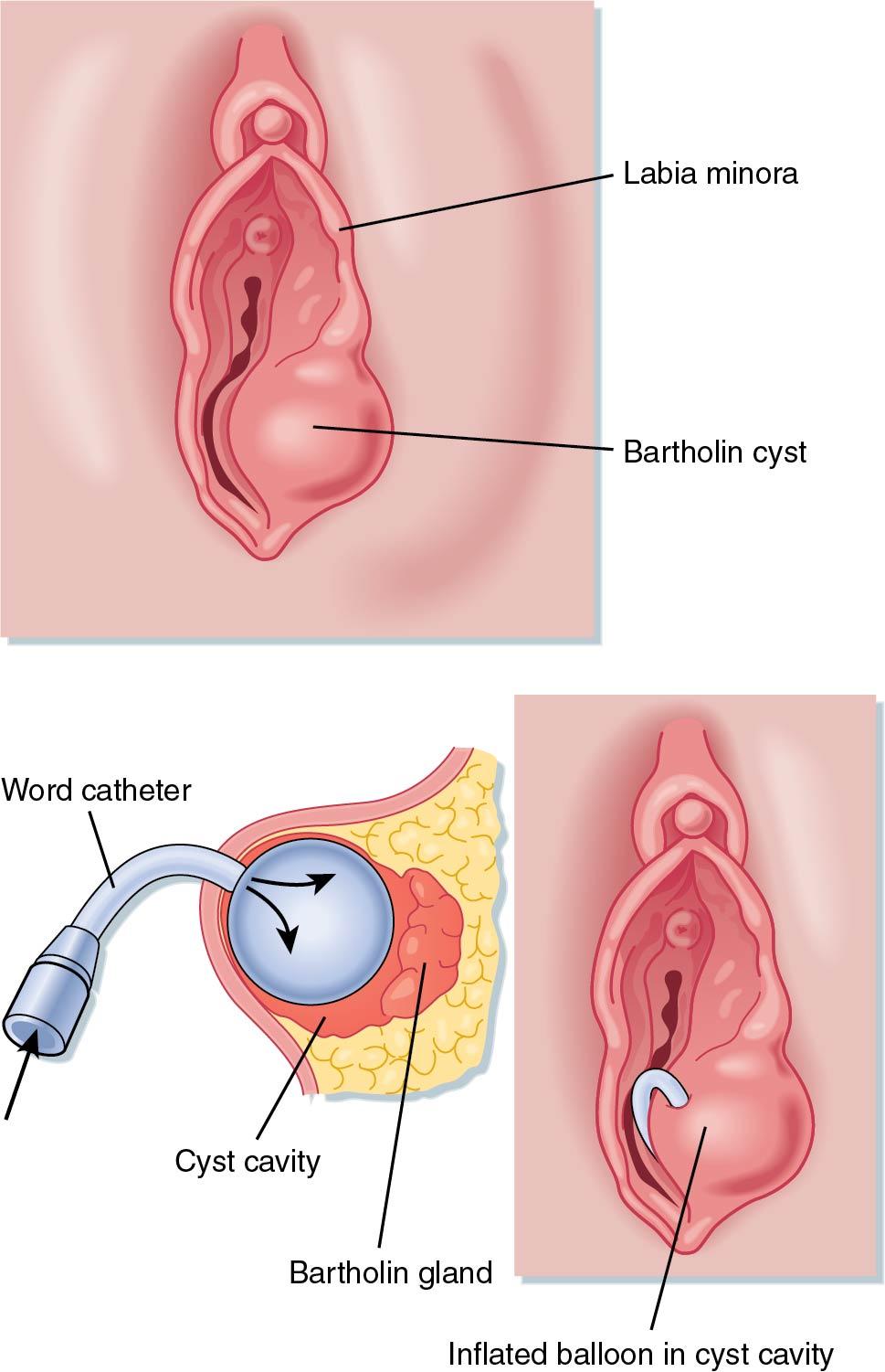 Fig. 3.5, A no. 11 scalpel incision is made inside the hymenal ring, making the opening just large enough to insert the Word catheter. The balloon is then inflated within the cavity of the cyst.