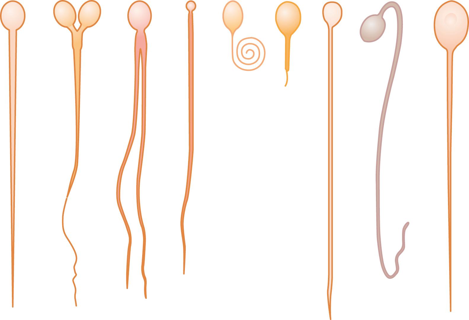 Figure 81-5, Abnormal infertile sperm, compared with a normal sperm on the right.