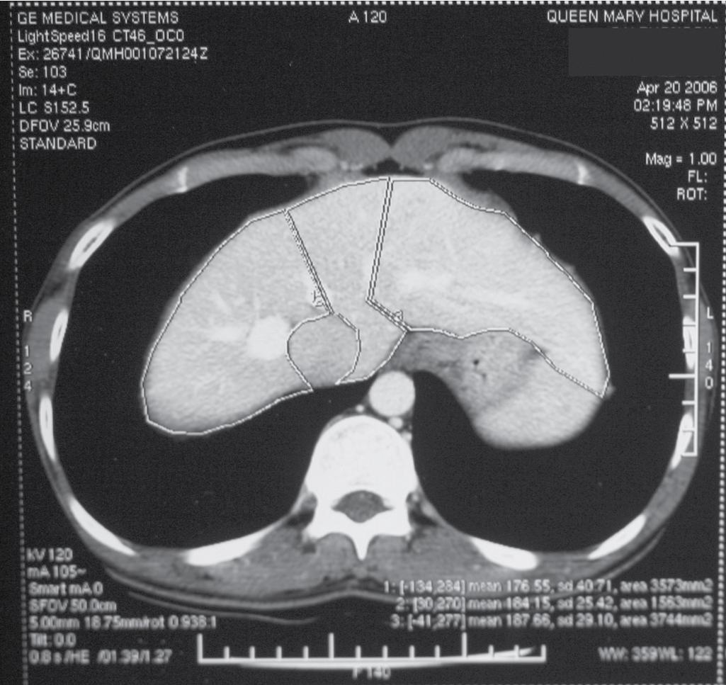 FIGURE 121.1, Volumetric analysis of the donor liver on computed tomography (see Chapter 102 ).