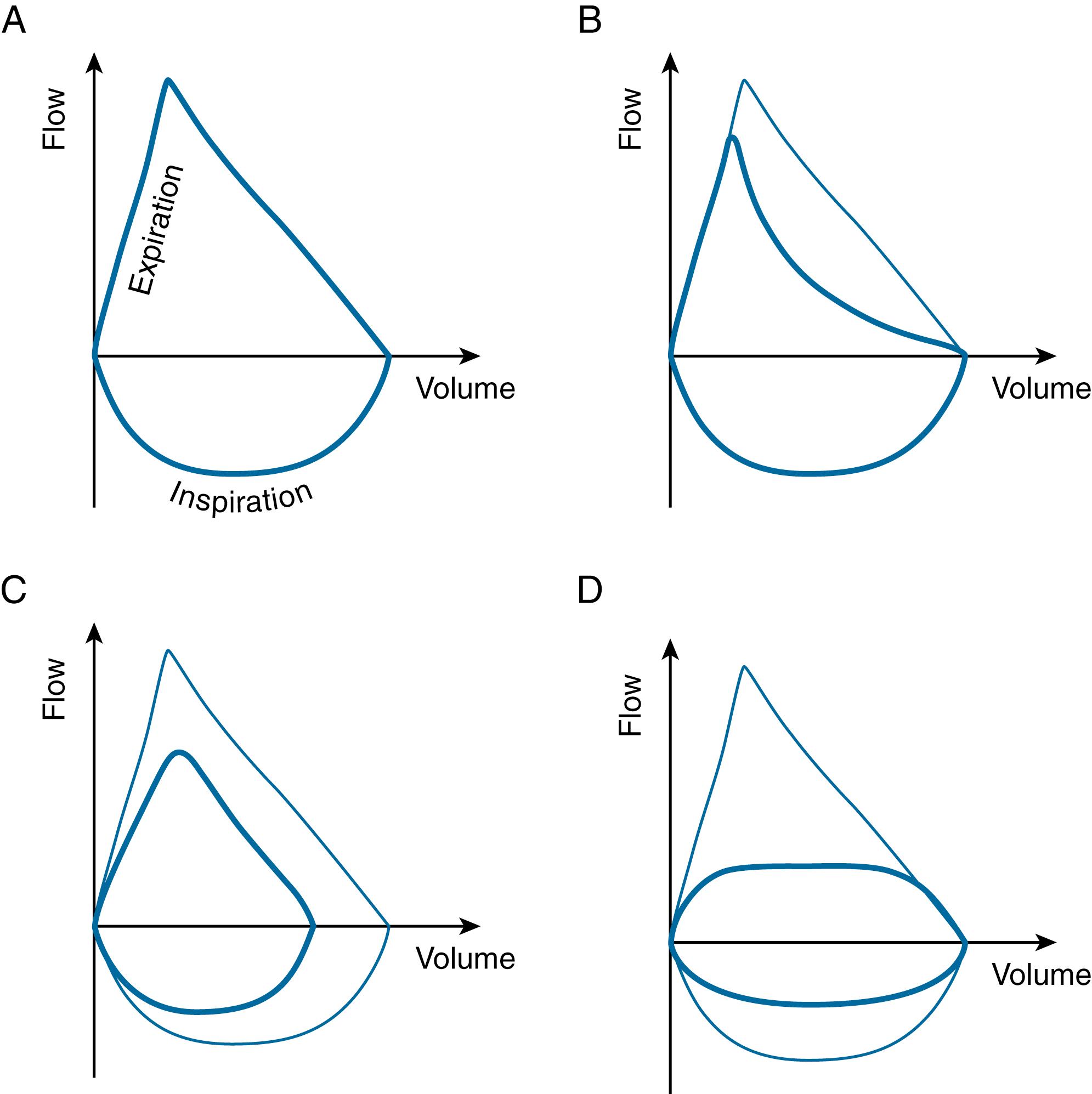 Fig. 17.1, Common patterns of flow volume loops.