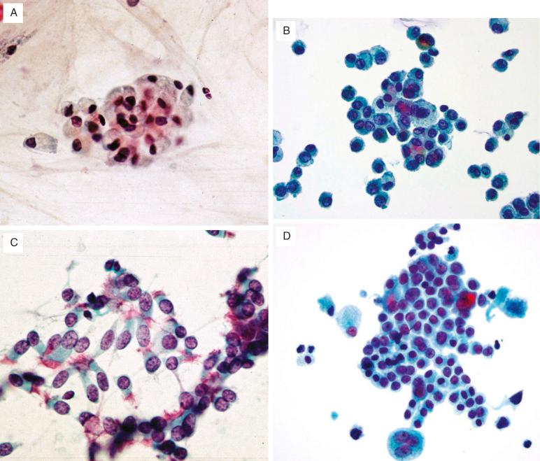 FIG. 36.1, Respiratory cytology techniques. (A) Numerous alveolar macrophages are required for a sputum sample to be adequate for diagnosis. (B) Bronchial washing and bronchoalveolar lavage samples consist predominantly of alveolar macrophages. Scattered ciliated bronchial epithelial cells may be seen. (C) Bronchial brushings consist predominantly of ciliated columnar respiratory epithelial cells. (D) Sheets of mesothelial cells are frequently seen in transthoracic fine-needle aspiration samples.