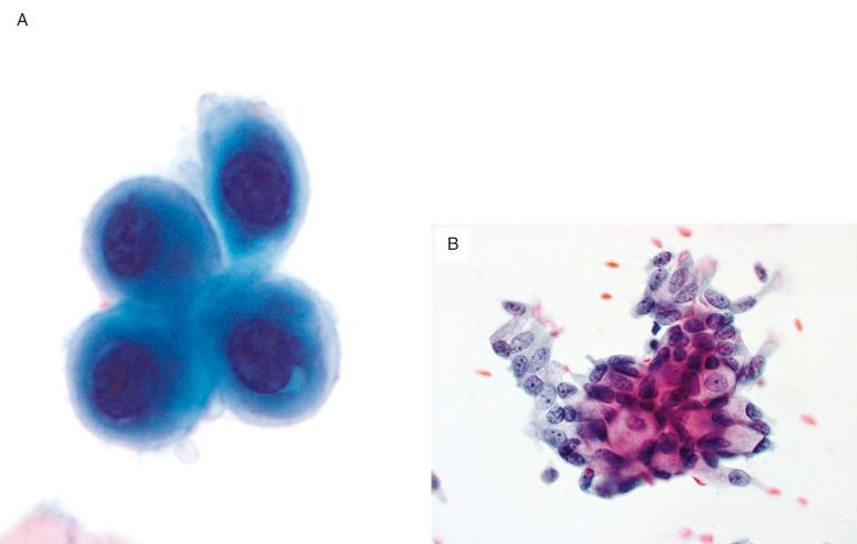 FIG. 36.2, Normal cellular elements. (A) In addition to bronchial epithelial cells and alveolar macrophages, squamous metaplastic cells are frequently seen in respiratory samples, particularly in the setting of inflammation/airway injury. (B) Goblet cells are generally few in number in respiratory samples. They appear as large columnar cells with abundant cytoplasm distended by a large vacuole. The nuclei of goblet cells are small and pushed to the periphery of the cell.