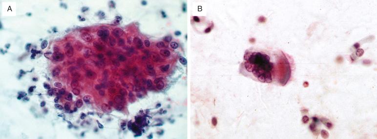 FIG. 36.3, Reactive cellular changes. (A) Reactive epithelium occurs in flat cohesive sheets. There is a spectrum of nuclear changes present. The nuclear-to-cytoplasmic ratio is maintained. Nuclei are enlarged with pale chromatin and consistent nucleolation. (B) Reactive bronchial epithelial cells are typically multinucleated. Ciliated cells in respiratory cytology samples are benign.