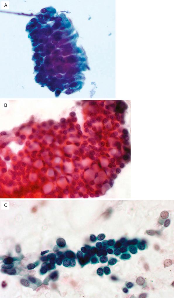 FIG. 36.4, Benign cellular proliferations. (A) As a group, benign cellular proliferations in the lung are important to recognize to avoid an overdiagnosis of malignancy. Bronchial cell hyperplasia (Creola body) represents full-thickness sloughing of the respiratory mucosa. This is a common finding in chronic inflammatory conditions, particularly asthma. Cilia provide a clue to the correct interpretation. (B) Goblet cell hyperplasia also occurs in response to mucosal injury and consists of aggregates of numerous goblet cells, which are seen here as cells distended by a mucin vacuole that pushes the nucleus to the periphery of the cell. Careful attention to the nuclear features allows distinction from adenocarcinoma. (C) Reserve cells, the most basal cells of the epithelium, proliferate in response to mucosal injury and function to regenerate the epithelium. These cells can show nuclear molding and can mimic small cell carcinoma. They tend to show less pleomorphism than small cell carcinoma and are often found in groups, sometimes with respiratory epithelial cells or metaplastic squamous cells. Necrosis and apoptotic debris are absent.