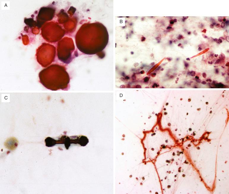 FIG. 36.5, Noncellular elements. (A) Corpora amylacea appear as spherical, acellular, noncalcified concretions. (B) Charcot-Leyden crystals, seen in the setting of eosinophil degranulation, are sharp, angulated, needlelike crystals. (C) A ferruginous body is an asbestos fiber coated with iron salts. It appears as a brown, rod-shaped structure with bulbous ends. (D) Curschmann spirals are coiled segments of inspissated mucus.