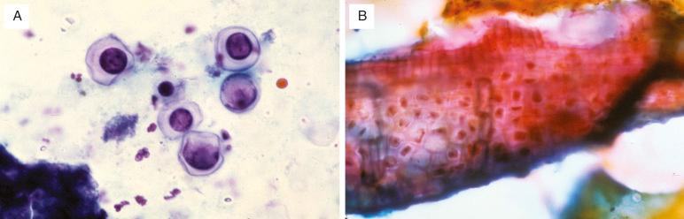 FIG. 36.6, Vegetable cells. (A) Individual vegetable cells can be mistaken for cells of adenocarcinoma. The thickened cell border provides a clue. (B) An intact vegetable fragment is confirmatory.