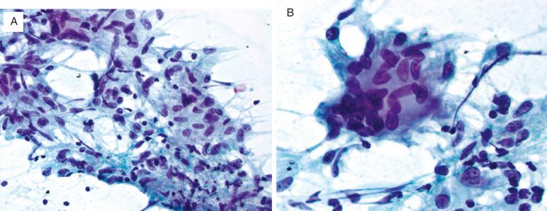 FIG. 36.7, Sarcoidosis. (A) A granuloma appears as a loose aggregate of epithelioid histiocytes with fibrillar cytoplasm and interspersed small lymphocytes. Necrosis is absent, but microbiologic cultures are necessary to exclude infection. (B) Multinucleated giant cells are frequently seen in association with granulomas.