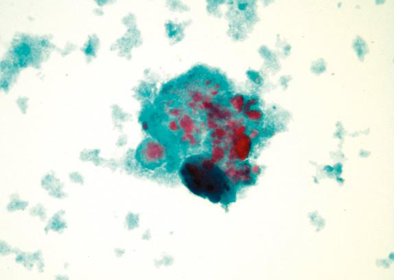 FIG. 36.8, Pulmonary alveolar proteinosis. Granular material from bronchoalveolar lavage fluid in a patient with pulmonary alveolar proteinosis.