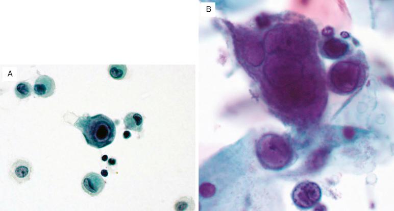 FIG. 36.9, Viral infections. (A) Cytomegalovirus infection causes cellular enlargement with a large central basophilic intranuclear inclusion surrounded by a pale halo. Chromatin is marginated to the periphery of the nucleus. (B) Herpes simplex–infected cells show multinucleation with nuclear molding, margination of chromatin, and intranuclear inclusions.