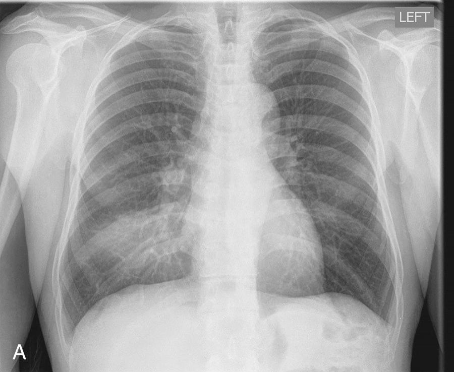 Fig. 43.1, Radiographic Images of Community-Acquired Pneumonia.