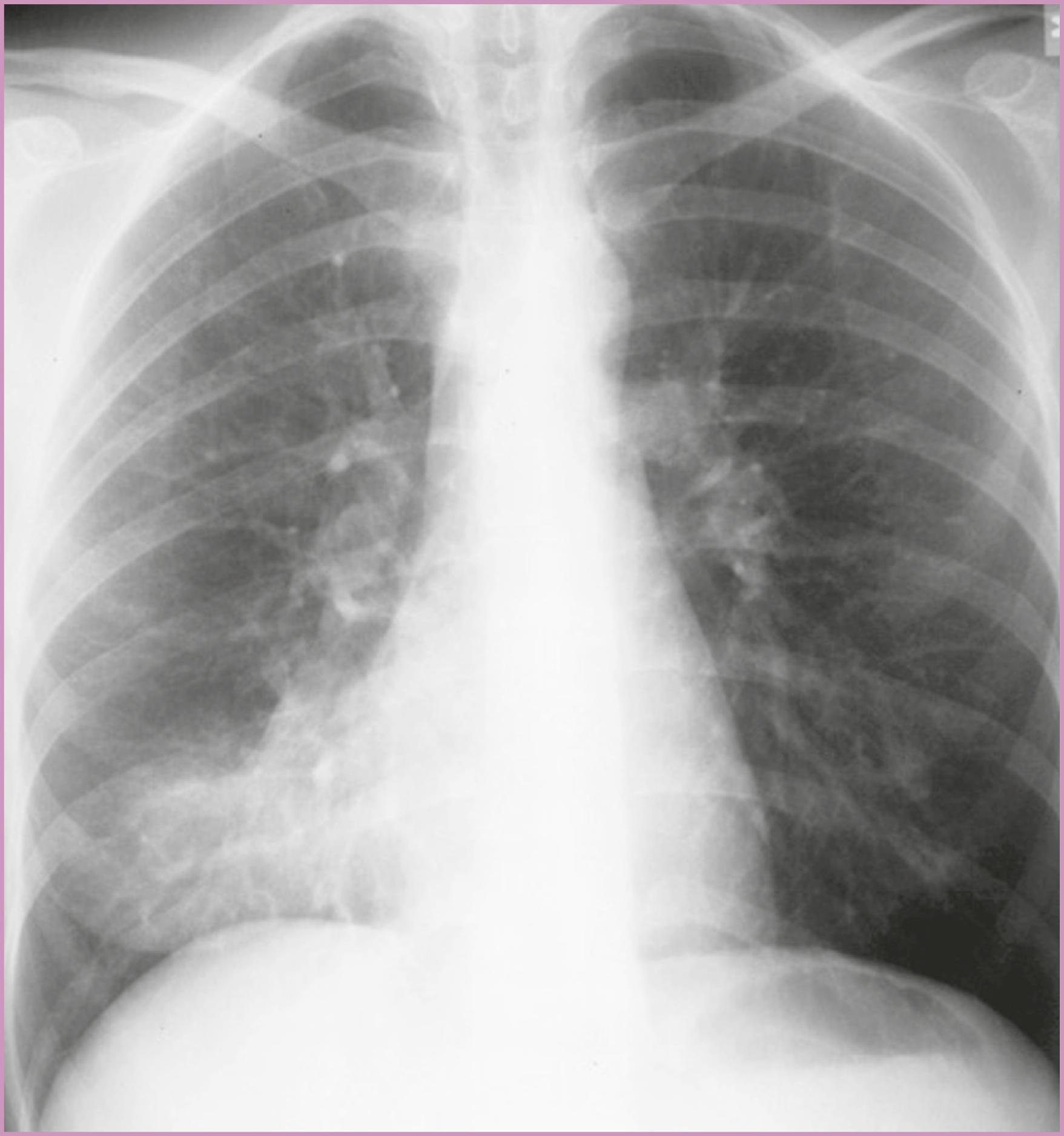 Figure 58.4, Right lower-lobe pneumonia.