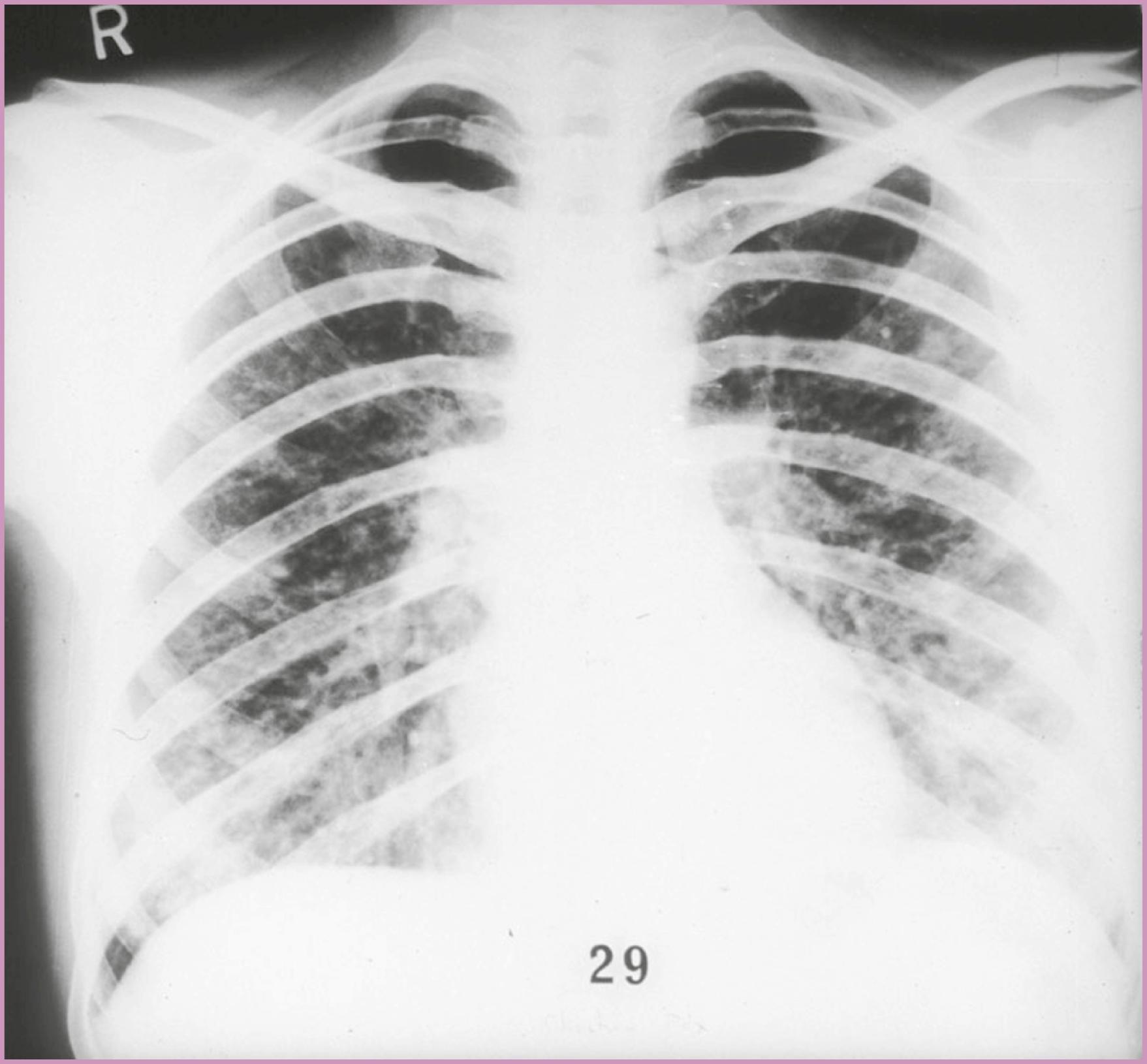 Figure 58.6, Varicella pneumonia.