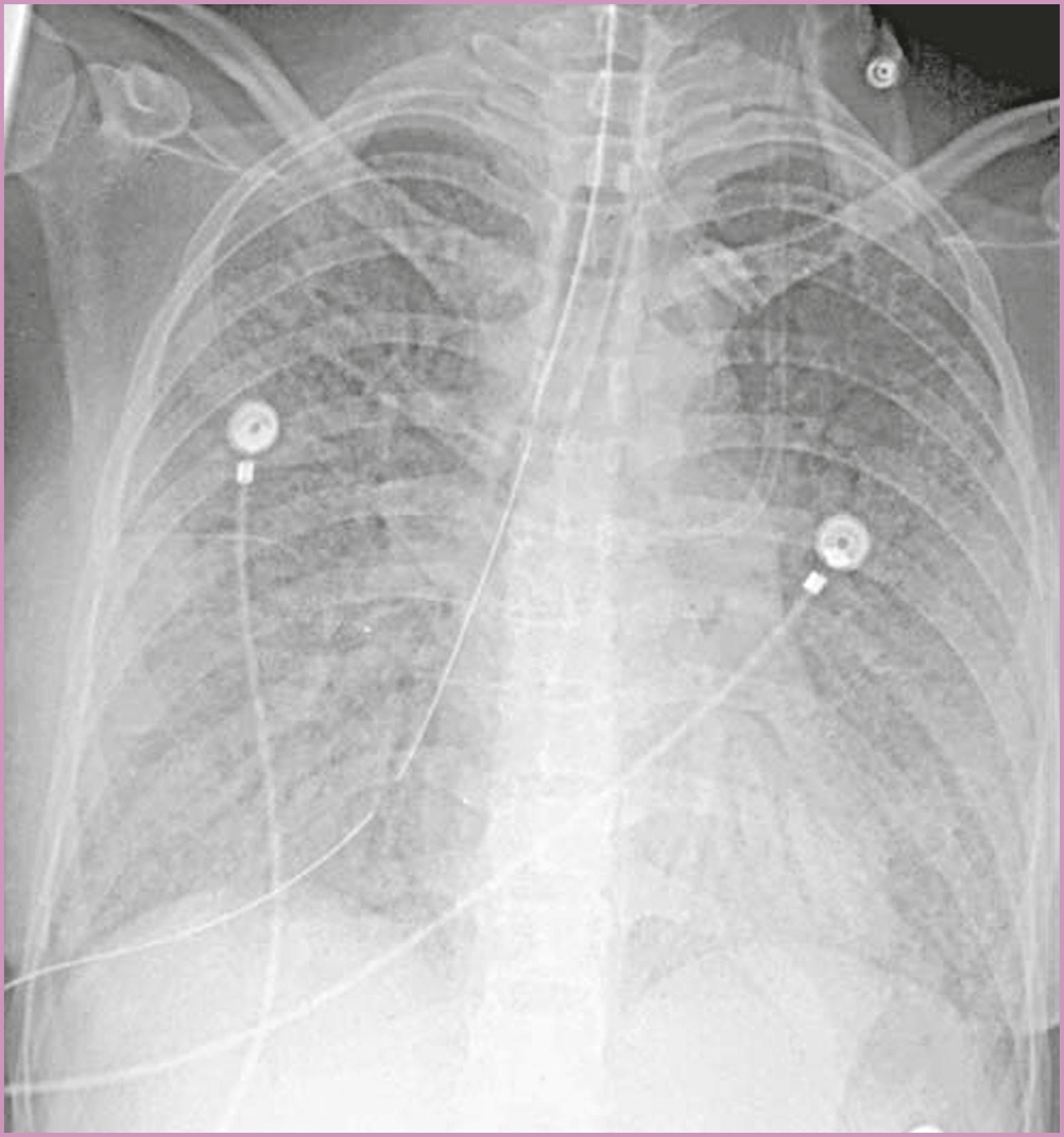 Figure 58.7, Pneumocystis jiroveci pneumonia (PJP).