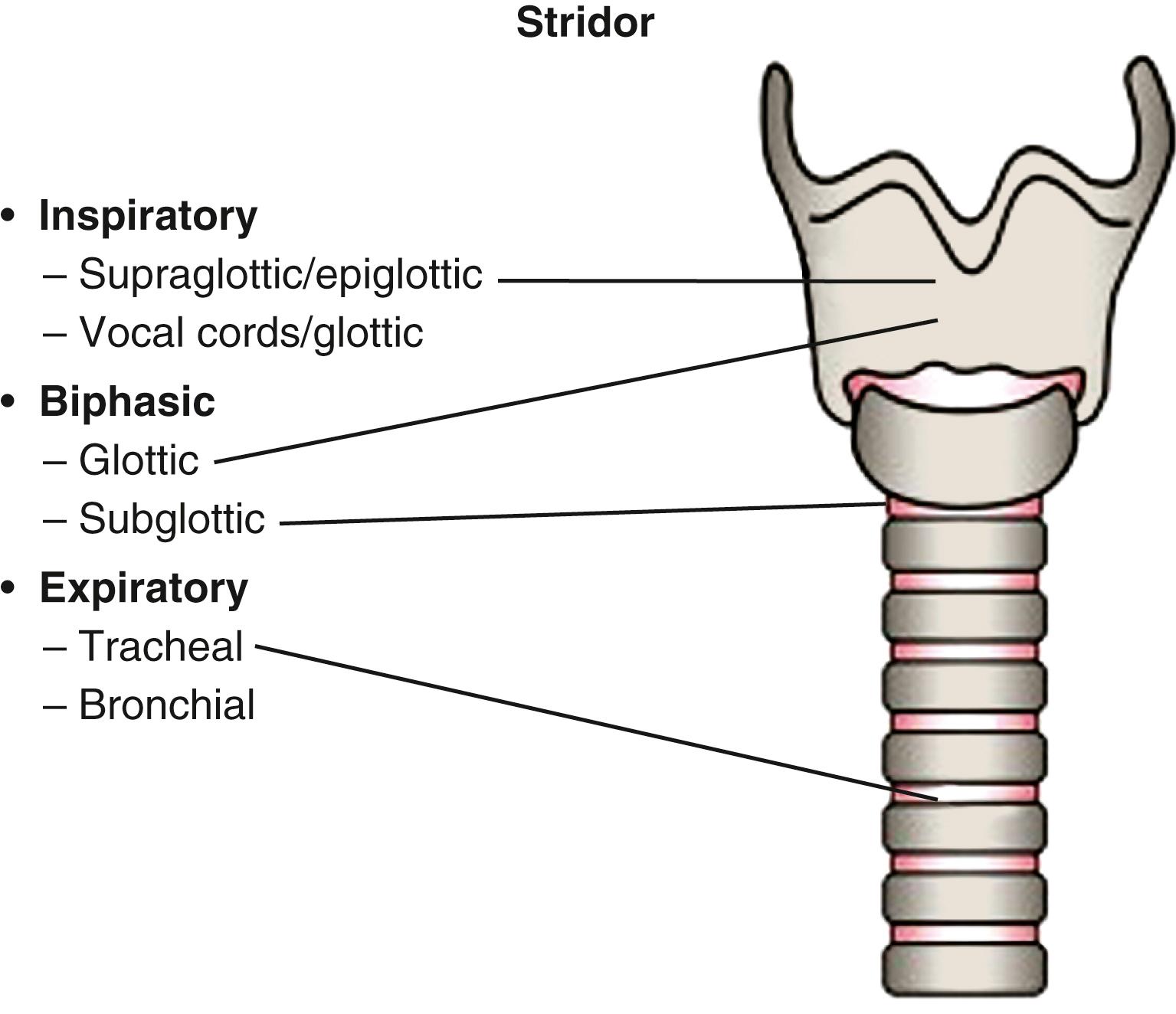 Fig. 4.1, Stridor. Inspiratory stridor is characteristic of partial airway obstruction at or above the vocal cords (supraglottic/epiglottic and glottis areas). Biphasic stridor is characteristic at the glottis or subglottic areas, and is typically caused by a fixed obstruction. Expiratory stridor is characteristic of a high tracheal lesion as there is a decrease in airway diameter with expiration.