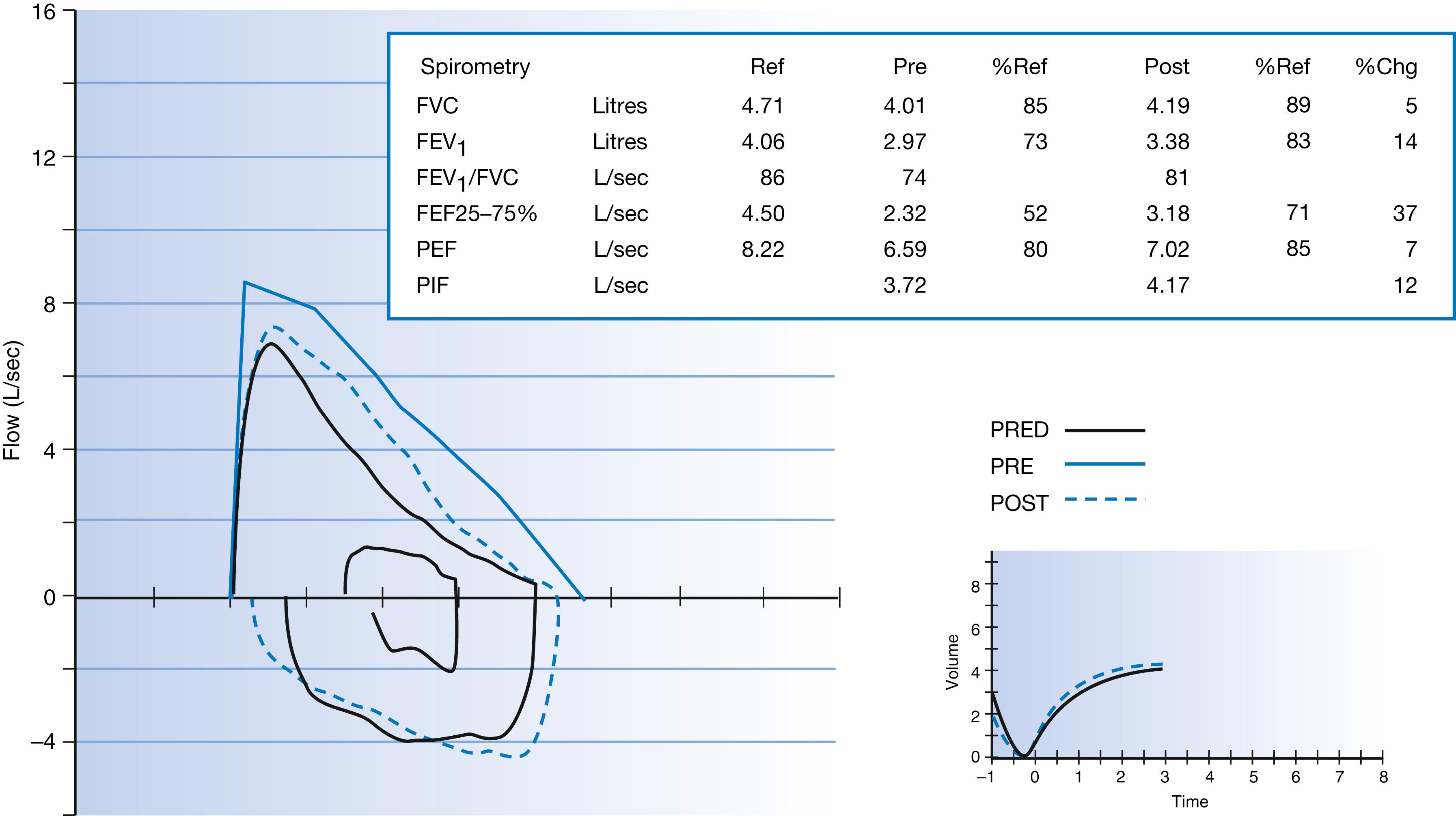 Fig. 4.2, Spirometry demonstrating a scooped flow volume loop seen in obstructive disease in asthma. Following bronchodilator use (PRED, predicted), there is a positive bronchodilator response of >12% in forced expiratory volume in 1 second (FEV 1 ). FEF, forced expiratory flow rate; FVC, forced vital capacity; PEF, peak expiratory flow rate; PIF, peak inspiratory flow rate.