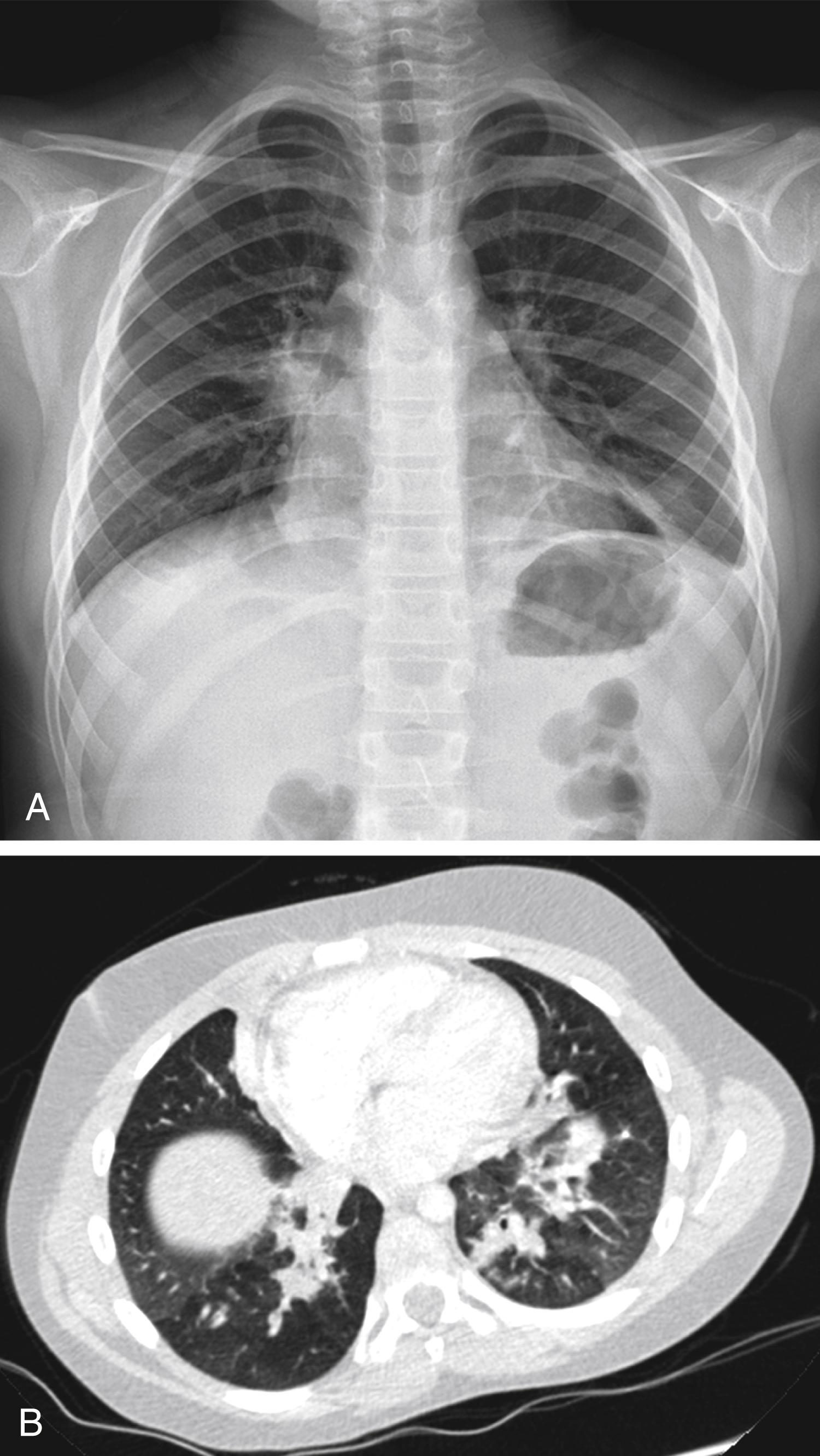 Fig. 4.6, Mycoplasma atypical pneumonia in an 8-year-old girl who presented with fatigue, low-grade fever, and cough. A, The chest radiograph shows irregularity of the right hilum and bibasilar infiltration. B, Contrast-enhanced CT demonstrates bilateral bronchopneumonia in the lower lobes. A direct fluorescent antibody test from nasopharyngeal aspirate confirmed the diagnosis.