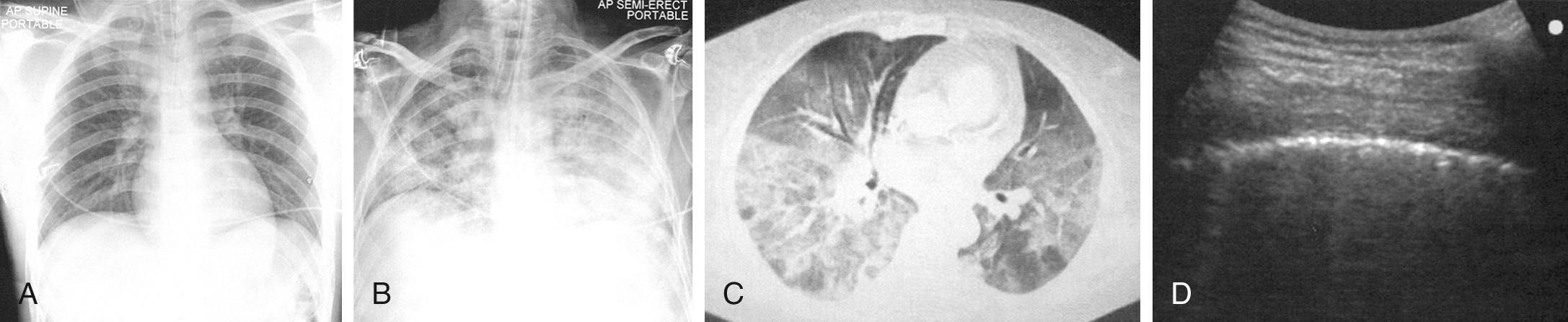 Fig. 89.1, Acute respiratory distress syndrome (ARDS).