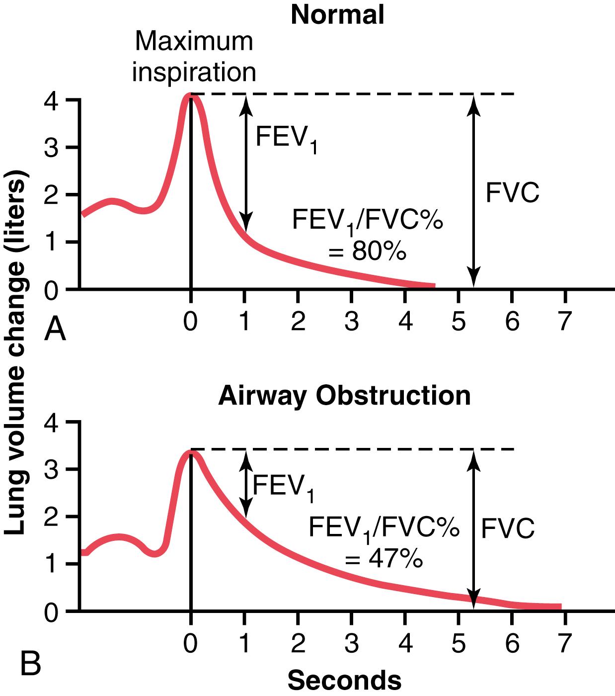 Figure 43-3, Recordings during the forced vital capacity maneuver in a healthy person ( A ) and in a person with partial airway obstruction ( B ). (The “zero” on the volume scale is residual volume.) FEV 1 , Forced expiratory volume during the first second; FVC, forced expiratory vital capacity.